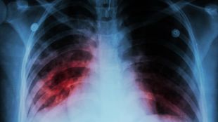 Новите случаи на туберкулоза по света са се увеличили за