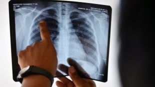 Франция отчита покачване на броя на заразени с туберкулоза през