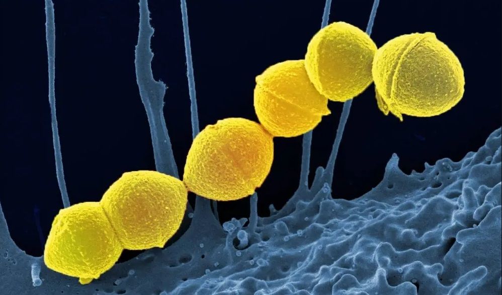Рядка, смъртоносна бактериална инфекция, разяждаща плътта, се разпространява с рекордна