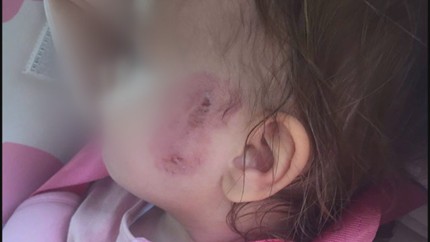 Медицинска сестра е уволнена след инцидента с нахапаната Никол в яслата