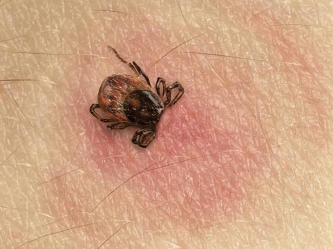 100 случая на лаймска болест и марсилска треска след ухапване от кърлежи