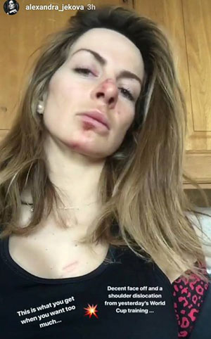 Жекова с извадено рамо и охлузвания