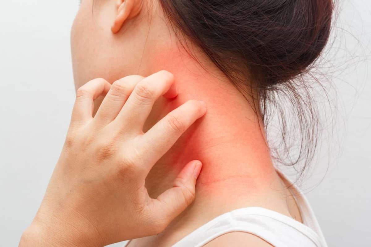 Как да предпазим кожата си от атопичен дерматит