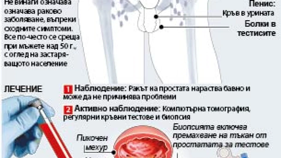 Очаква се бум на рака на простатата (ИНФОГРАФИКА)