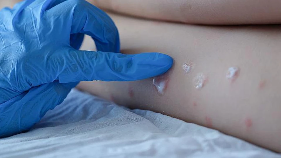 Регистрираха случай на маймунска шарка в София