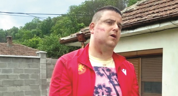 Проснали го с електрошок той е със счупена челюст и