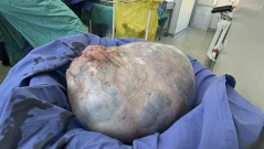 20-килограмов тумор отстраниха лекари в София от тялото на 82-годишна жена
