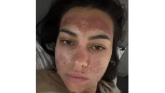 Млада жена с втора степен изгаряния по лицето след "билков" пилинг за 630 лв. (ОБНОВЕНА)