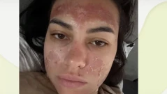 Кървене, гной и изгаряния: „Билков“ пилинг обезобрази млада майка