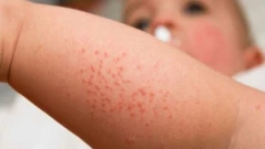 Окончателно: ваксината против варицела става задължителна в България