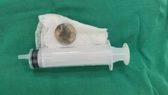 9-годишно дете погълна монета, която заседна в хранопровода му