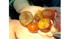 Камъни в жлъчката с рекордни размери извадиха от жена в Пернишката болница (СНИМКИ)