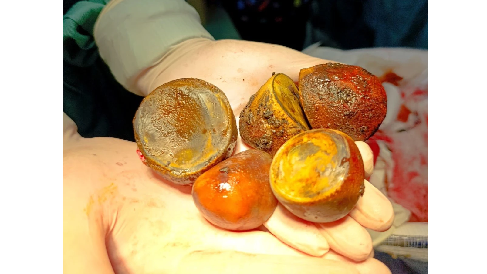 Камъни в жлъчката с рекордни размери извадиха от тялото на